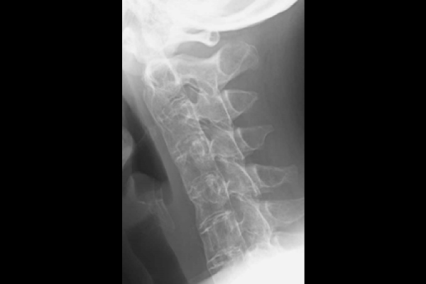 Plain X-ray image